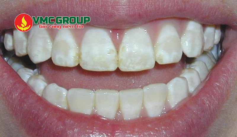 Acid citric có thể làm hại men răng nếu sử dụng không đúng cách